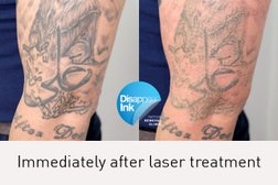 Disappear Ink Tattoo Removal Clinic in New South Wales
